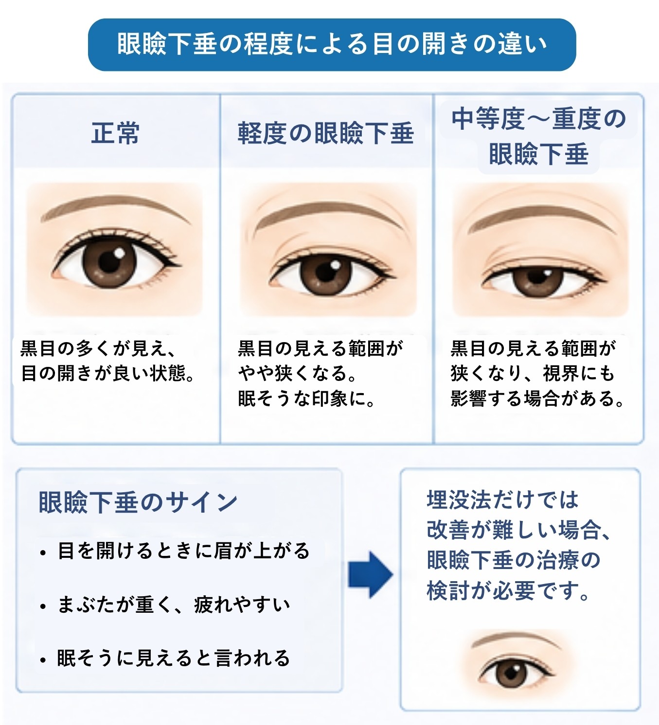 眼瞼下垂の程度による目の開きの違い