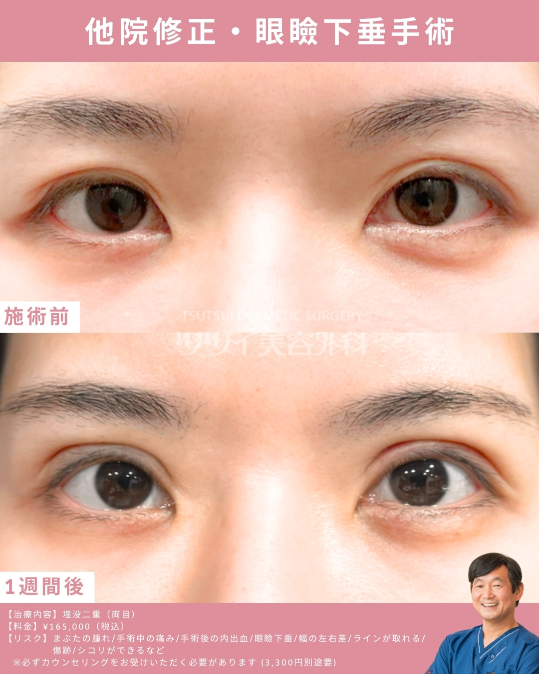 眼瞼下垂治療症例(他院修正)