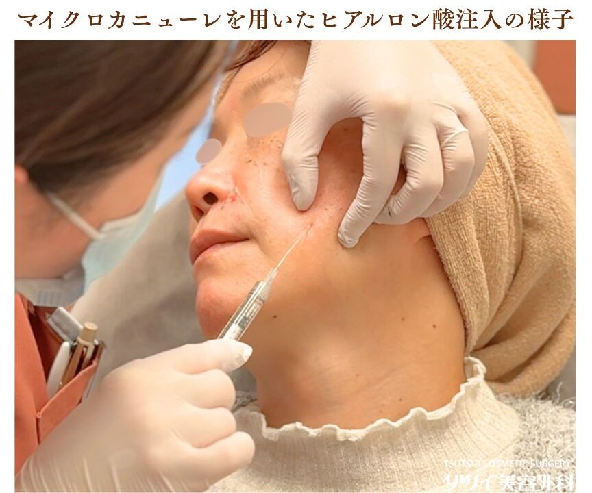 ヒアルロン酸_マイクロカニューレでの注入