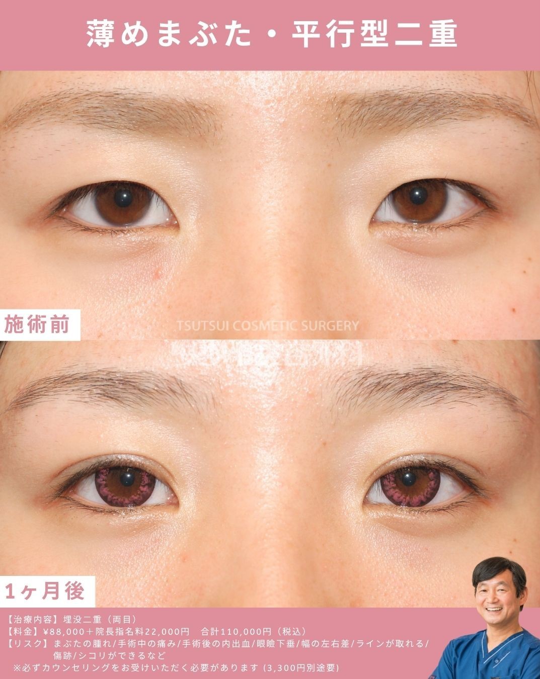 薄めまぶた平行型二重