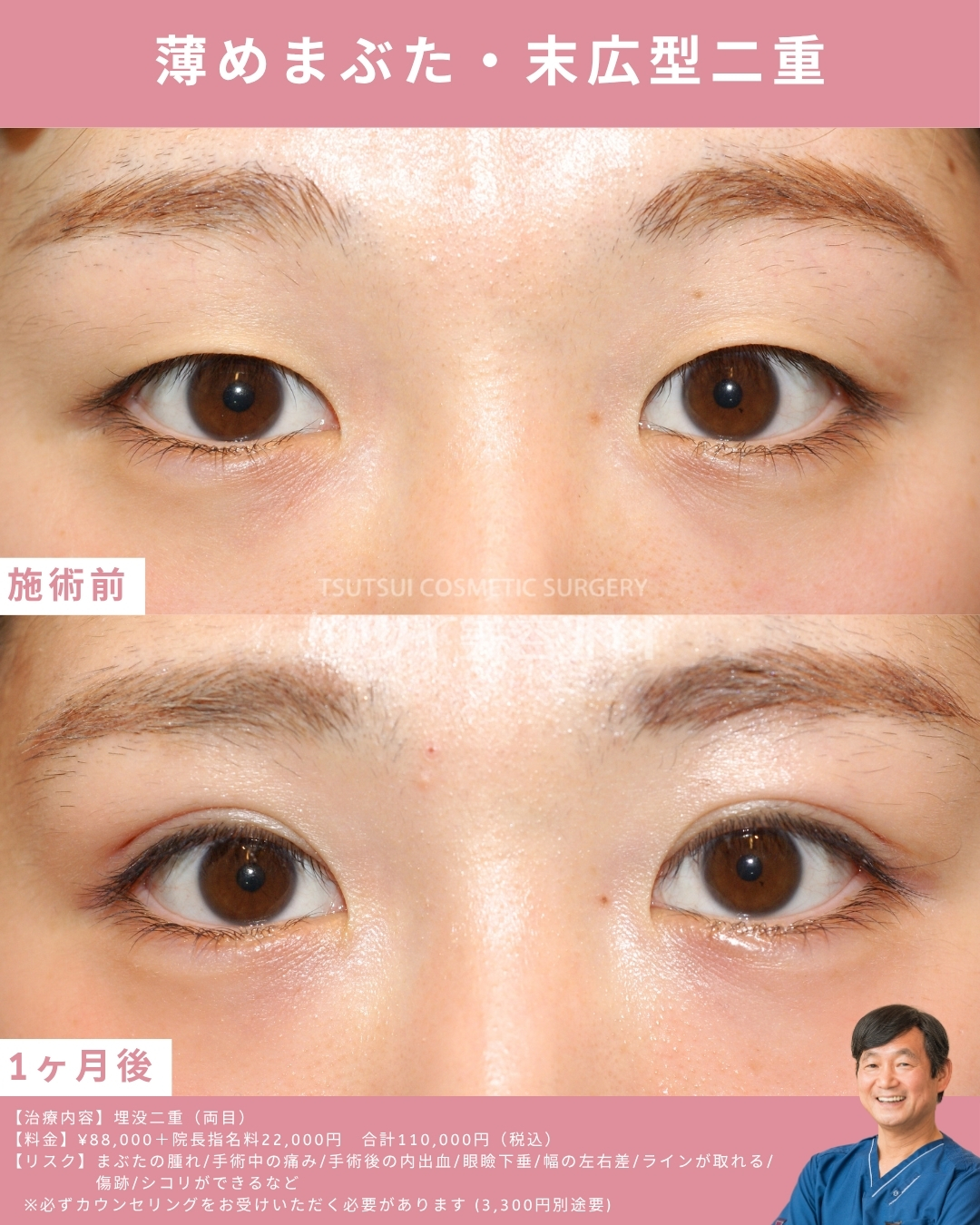 薄めまぶた末広型二重