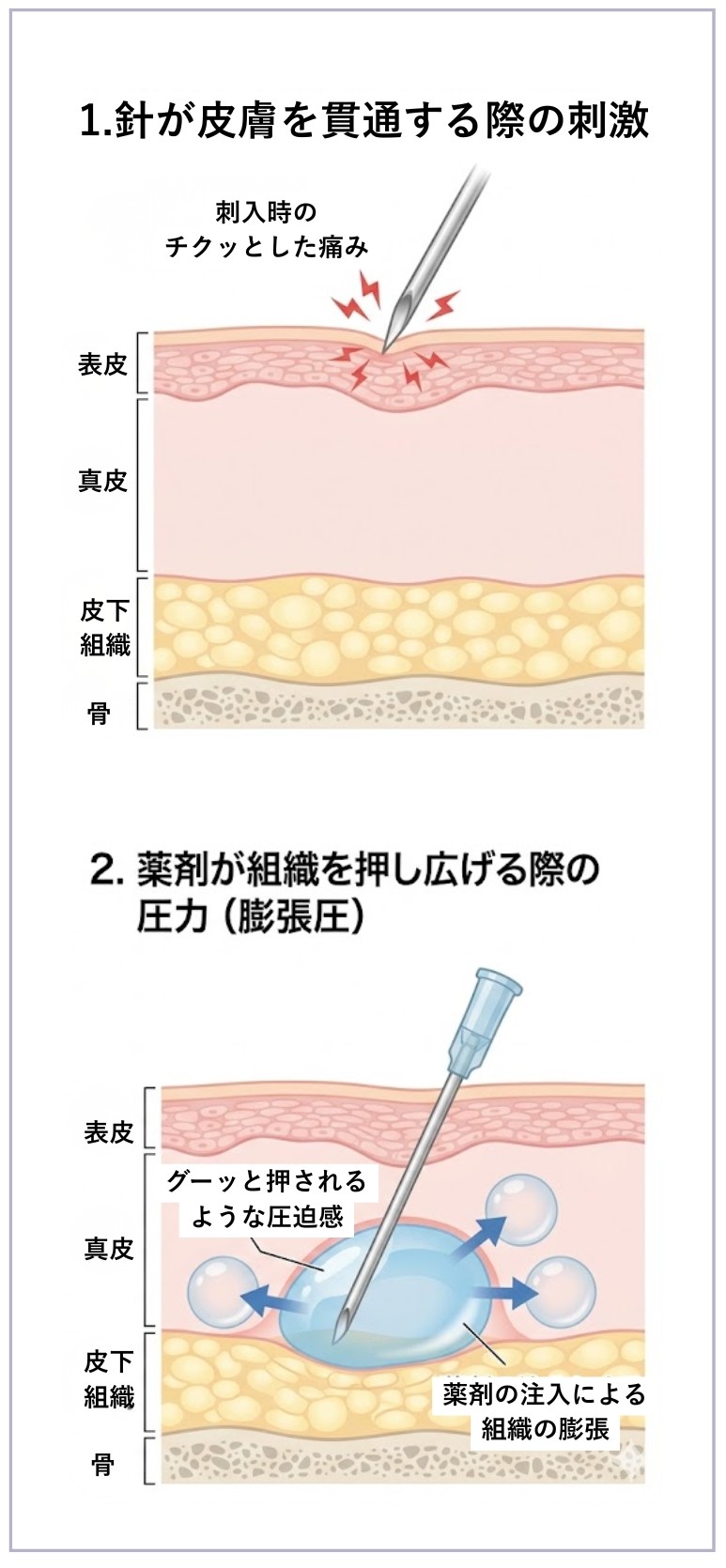 針が皮膚を貫通する際の刺激と膨張圧