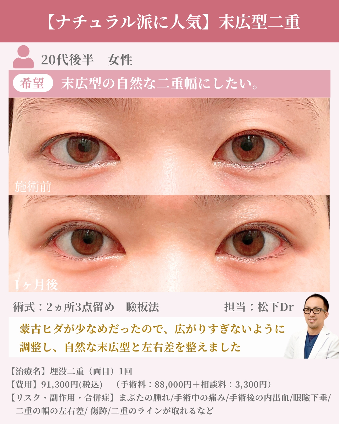 ナチュラル末広型二重症例