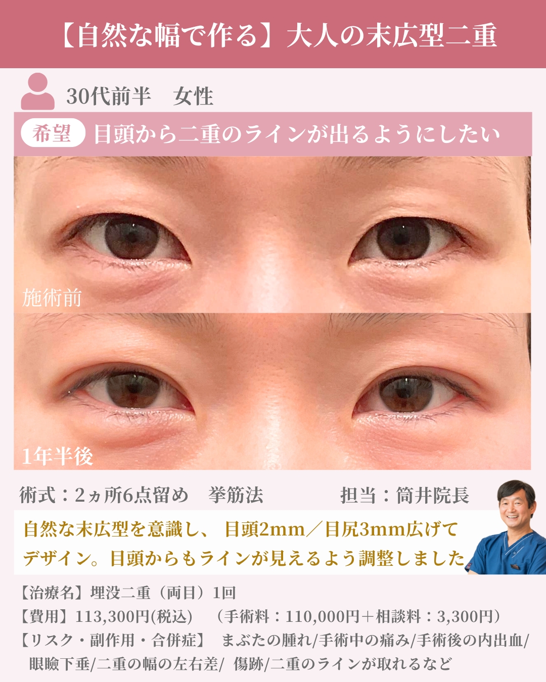 大人の末広型二重症例