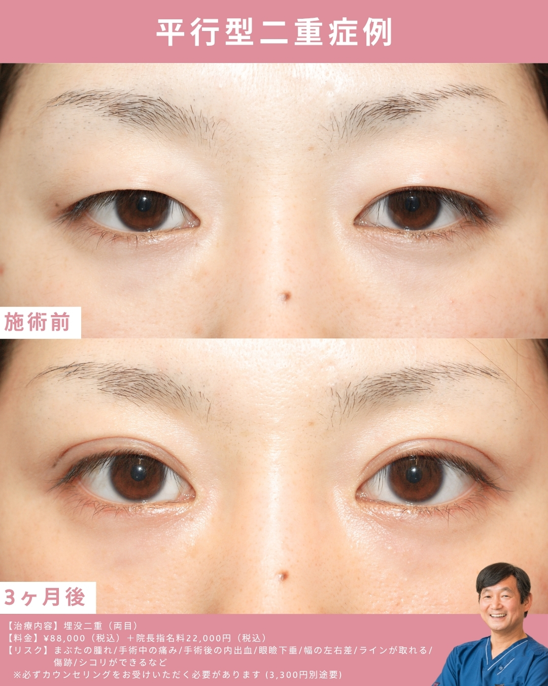 平行型二重症例