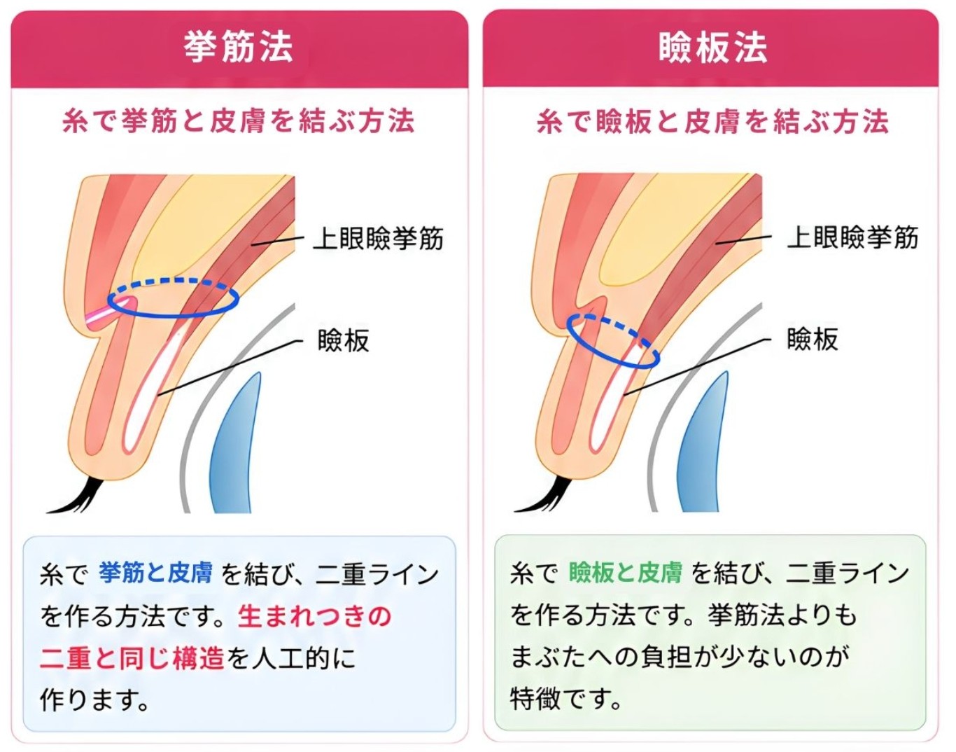 挙筋法と瞼板法の違い