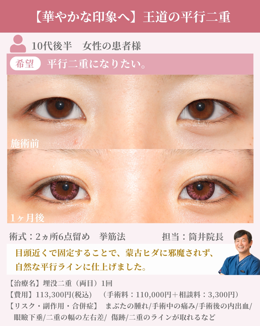 王道の平行二重