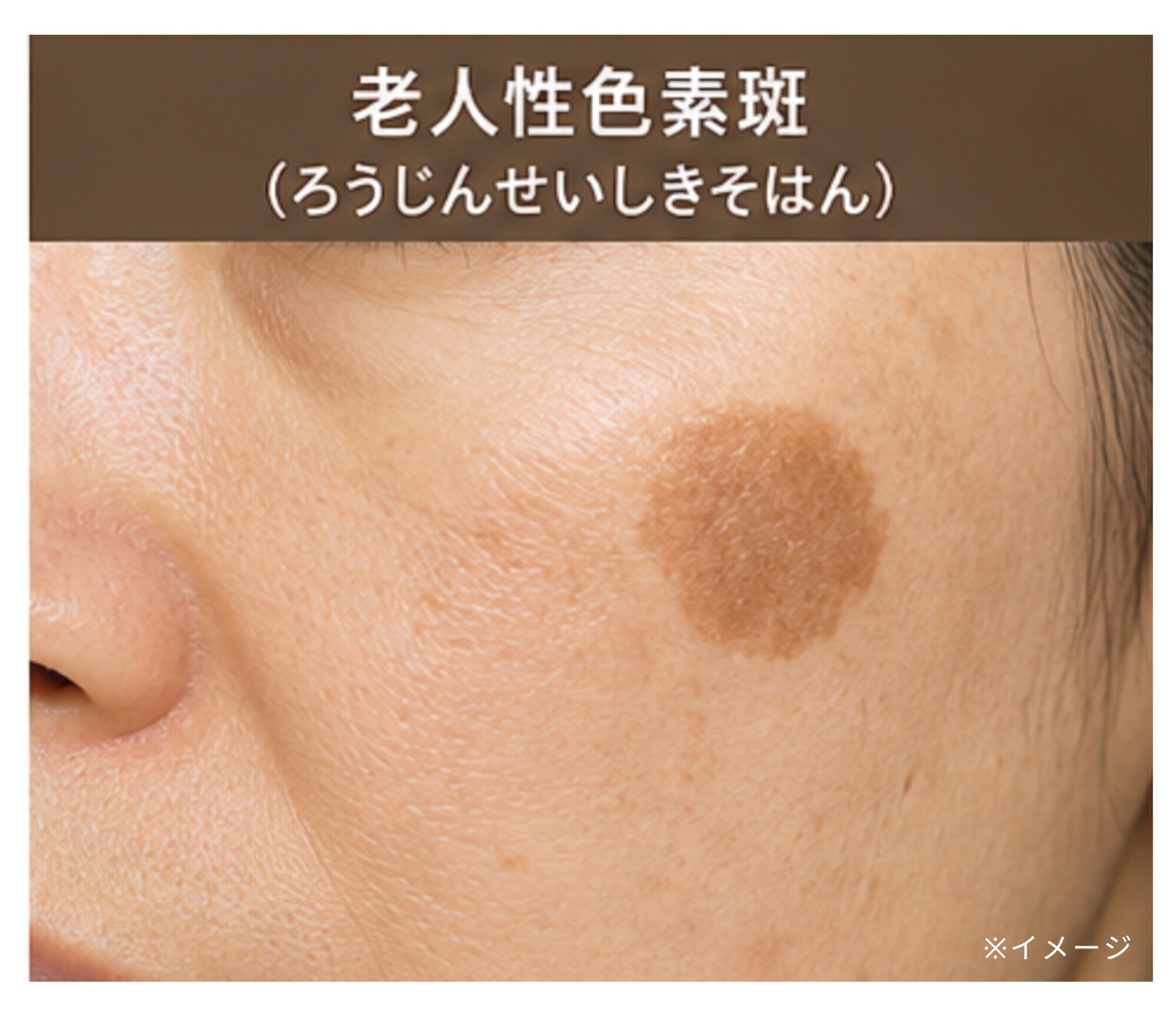 老人性色素斑のイメージ画像
