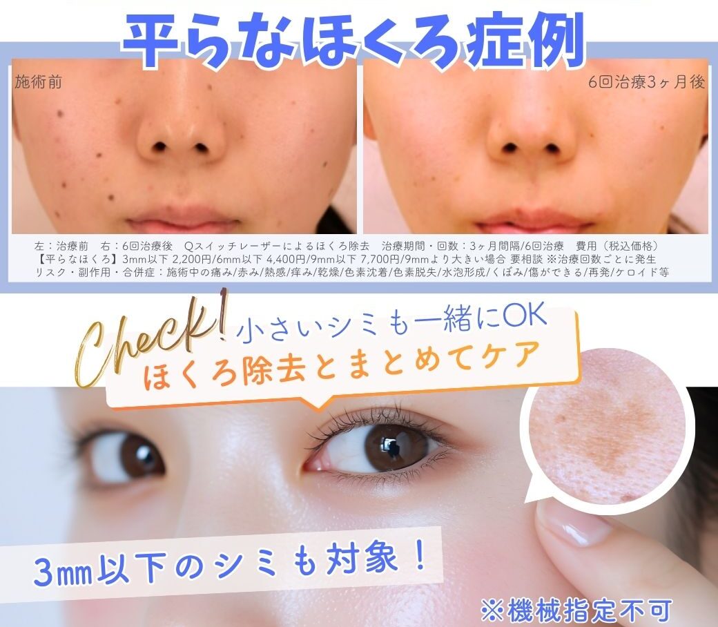 平らなほくろ症例