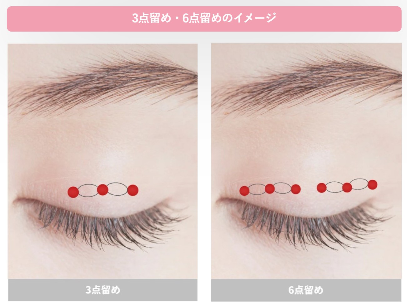 埋没法_3点留め6点留めのイメージ