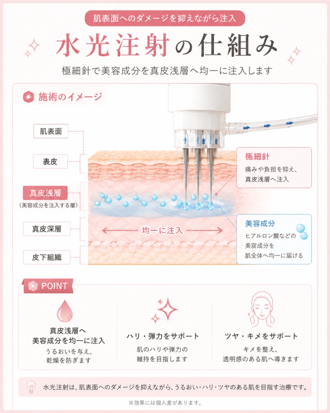 水光注射の仕組み