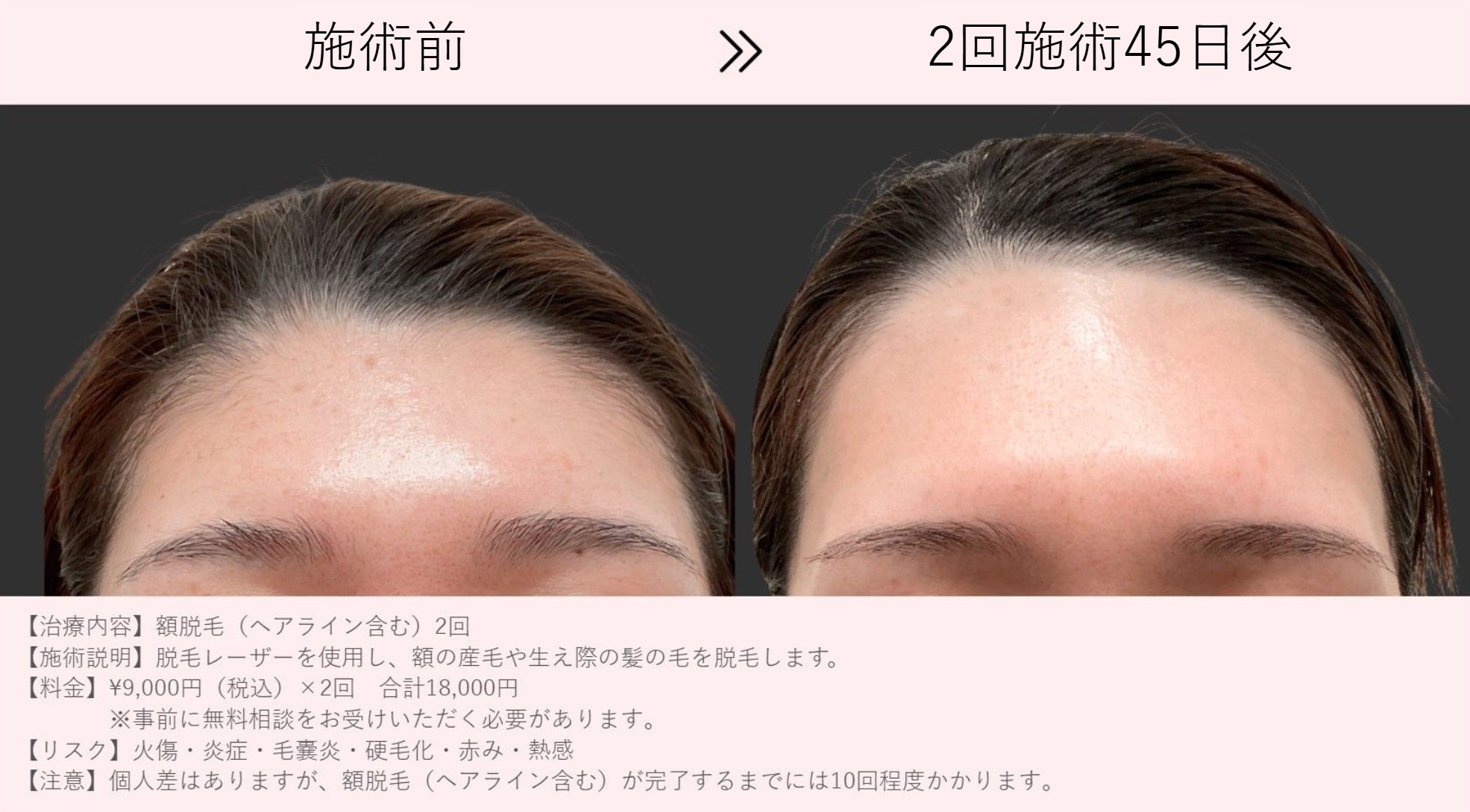 額脱毛症例