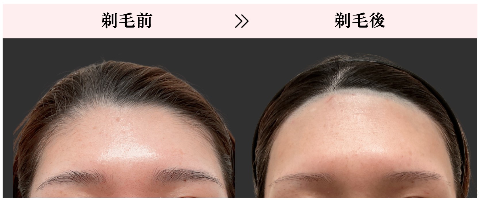 額脱毛_剃毛前と後の写真