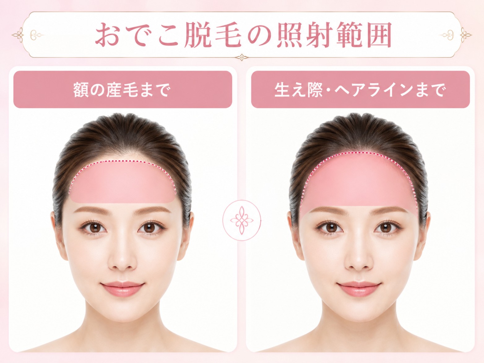 額脱毛_産毛までとヘアラインまでの違い
