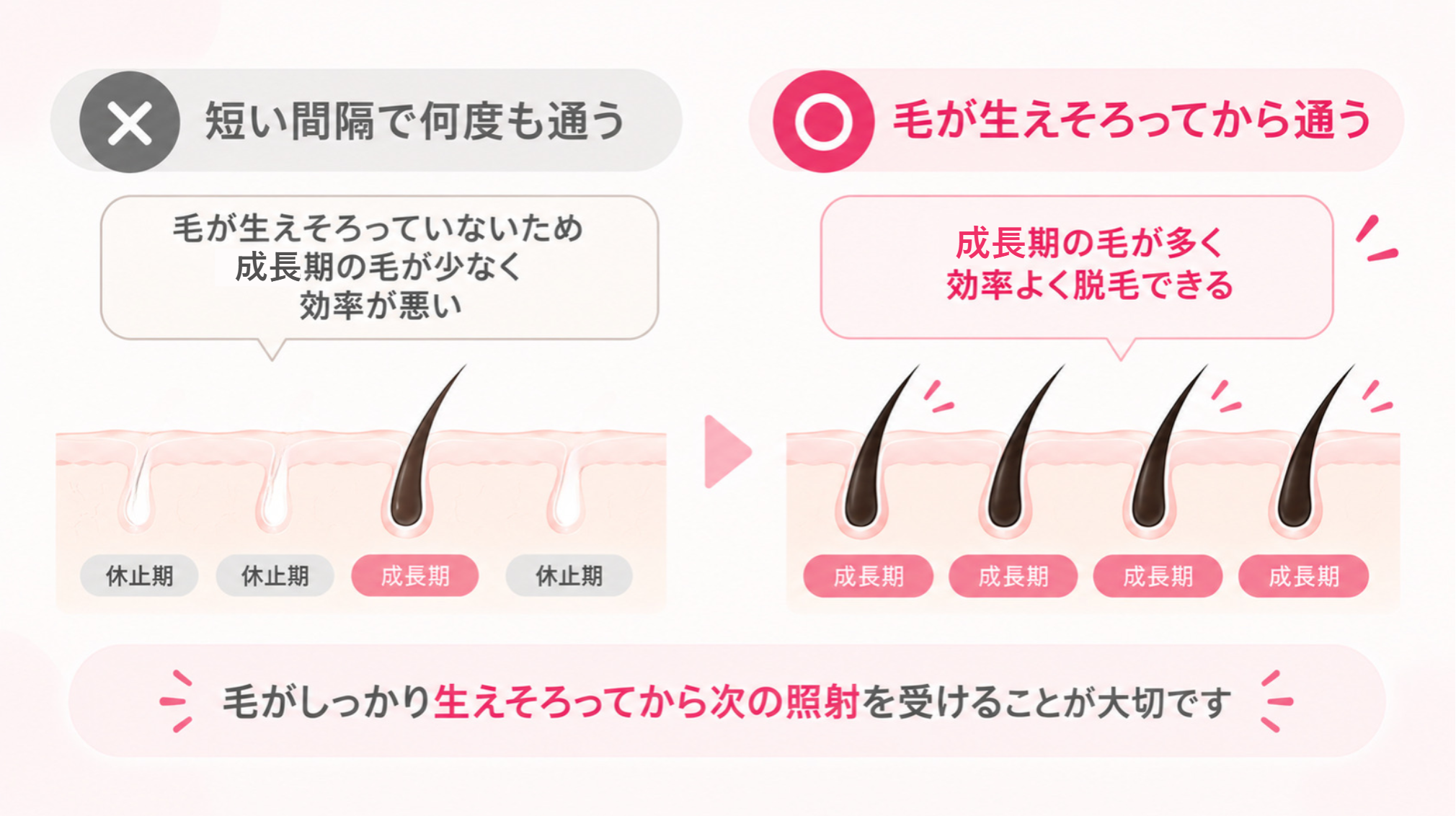 毛がしっかり生えそろってから次の照射を受けることが大切です
