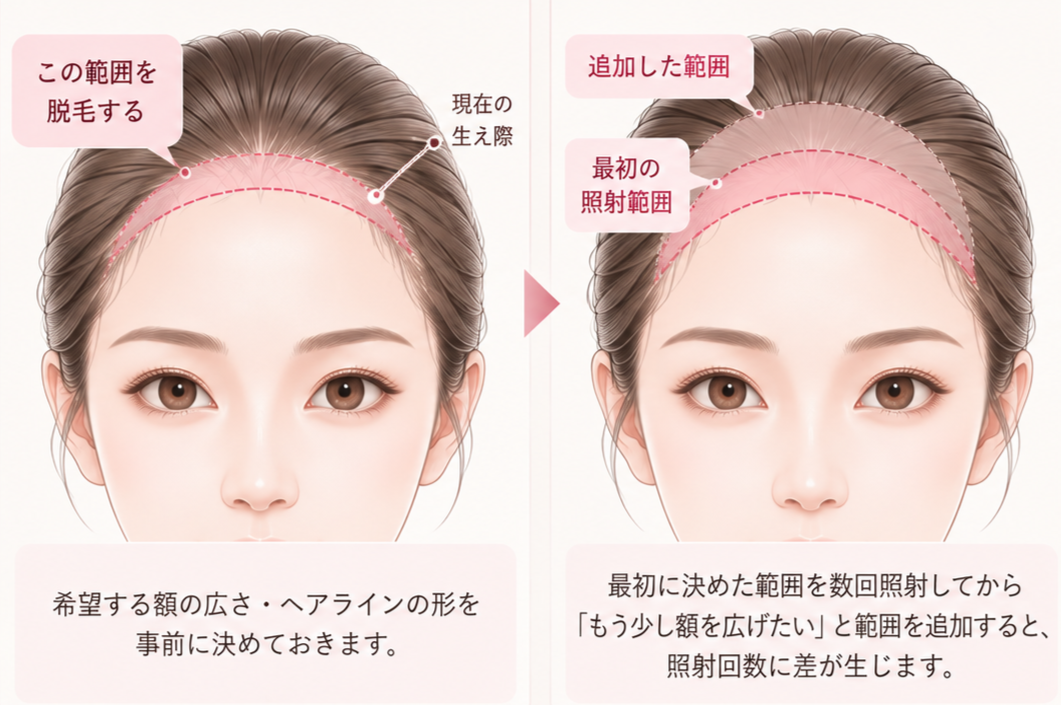 希望する額の広さ・ヘアラインの形を事前に決めておく
