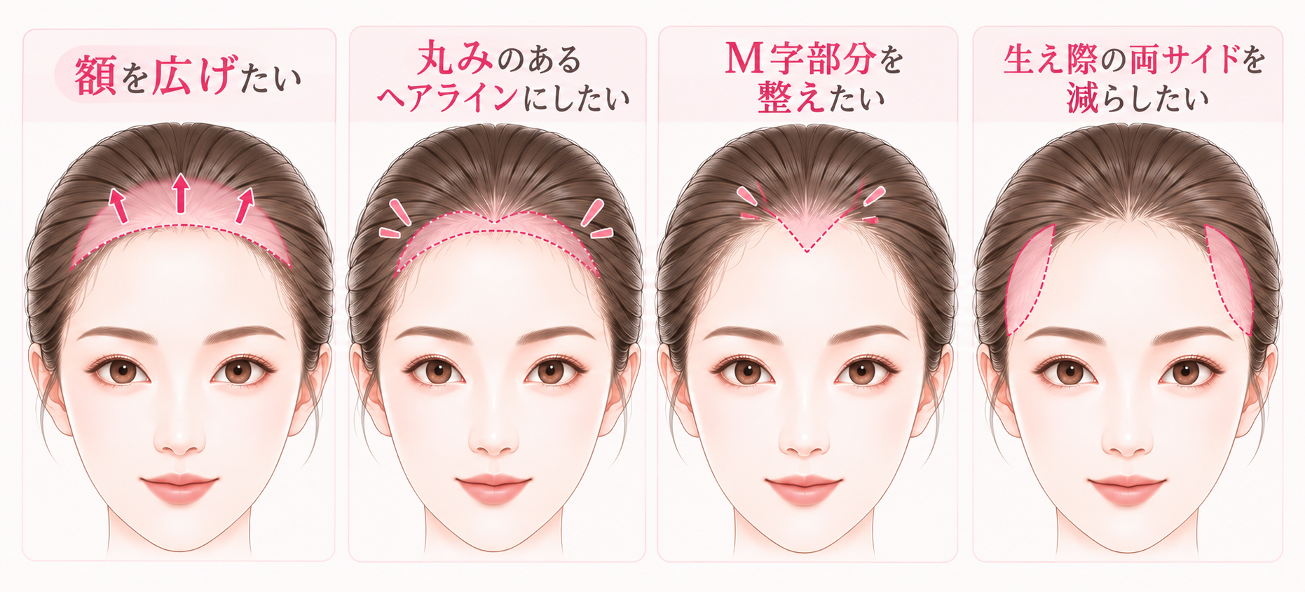 額脱毛いおける、デザインの種類