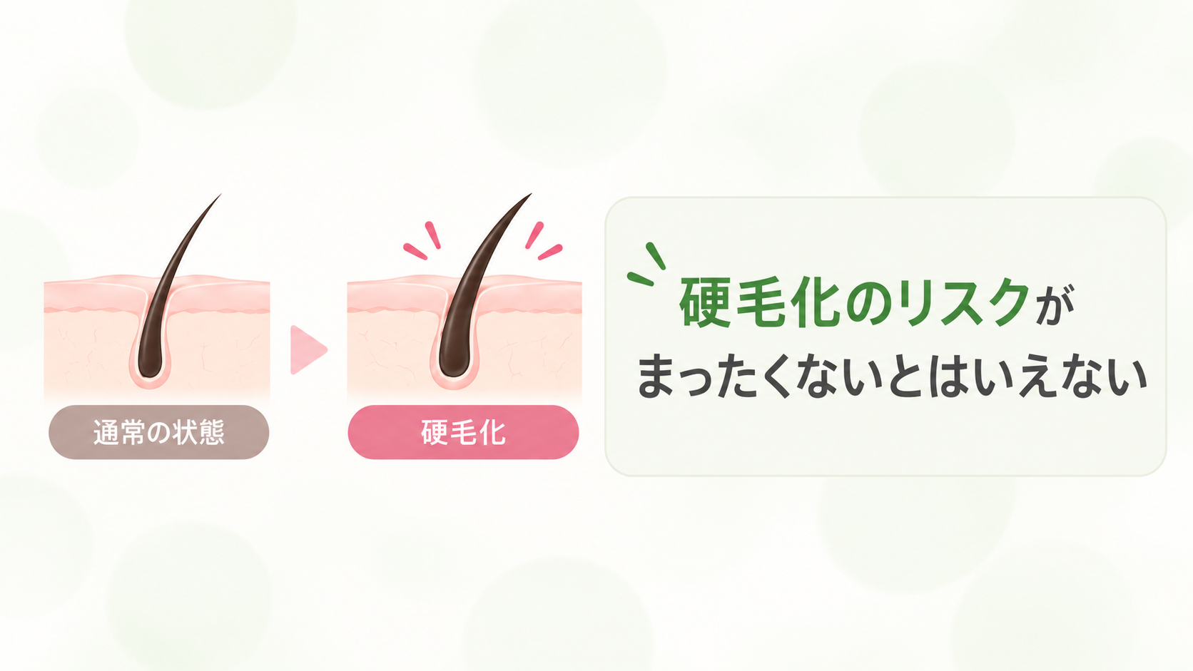 硬毛化のリスクがまったくないとはいえない