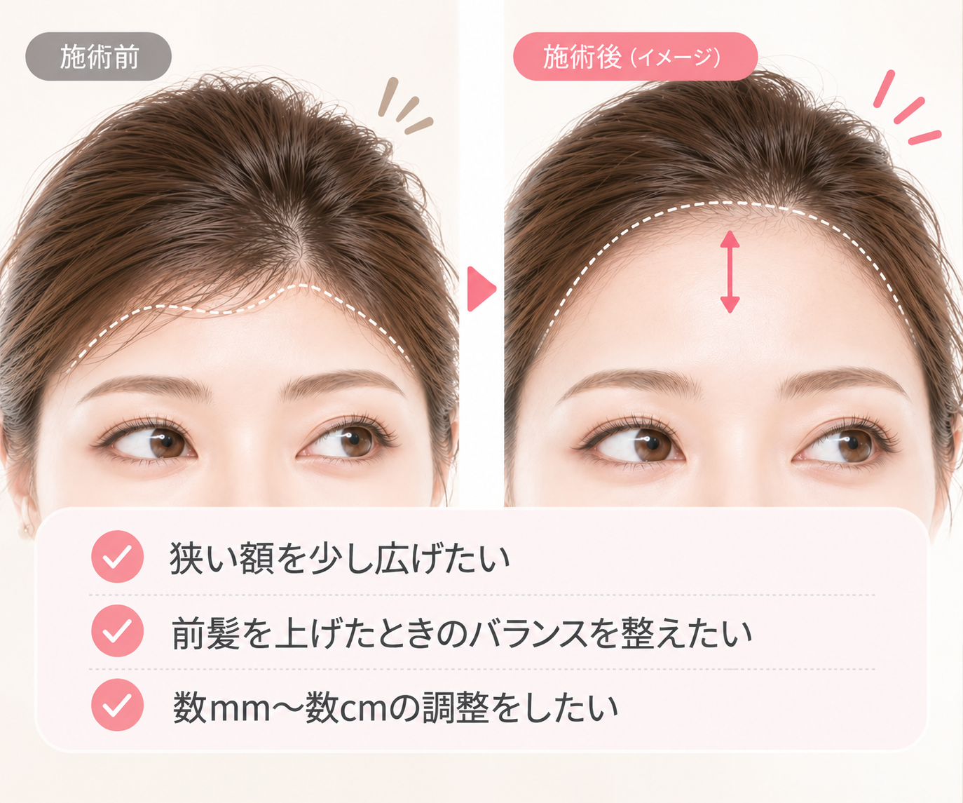 生え際を整えて額を広く見せる