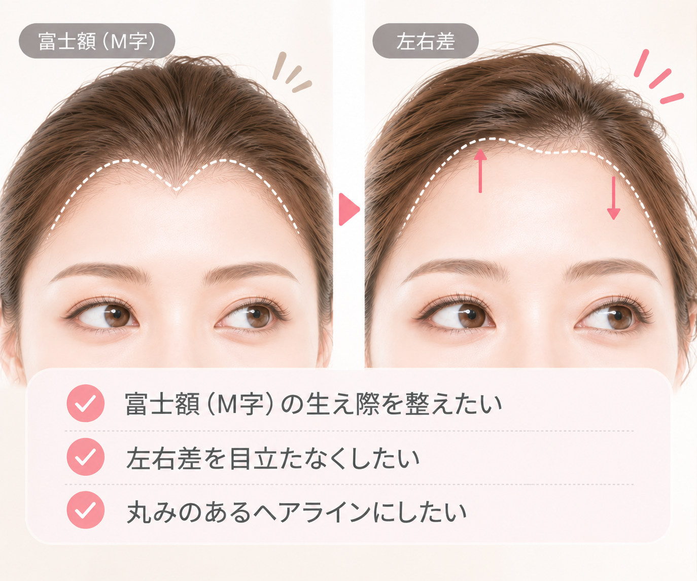 富士額(M字)・左右差などのヘアラインを整える