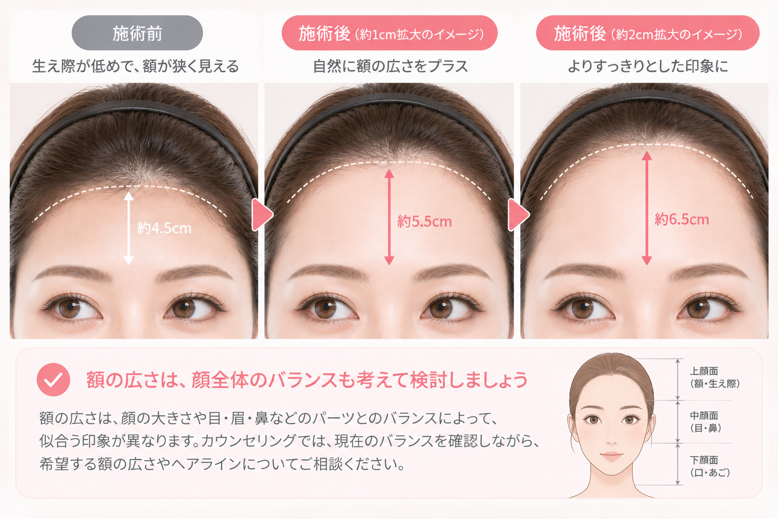 額を広げたい人が知っておきたい「生え際脱毛」の考え方