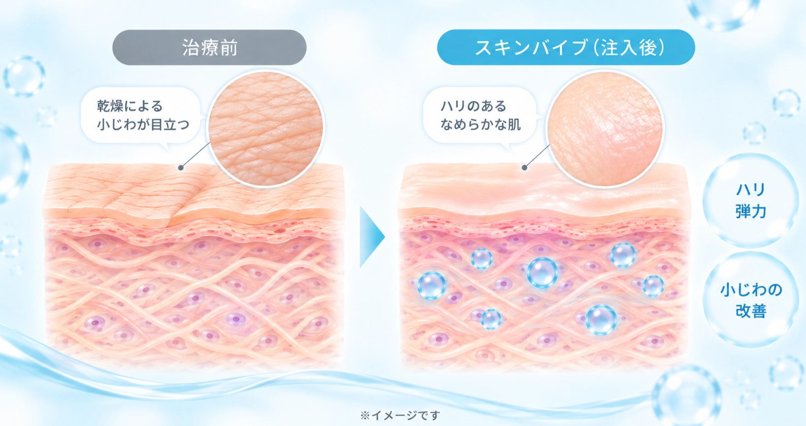 治療前の肌とスキンバイブ注入後のイメージ画像