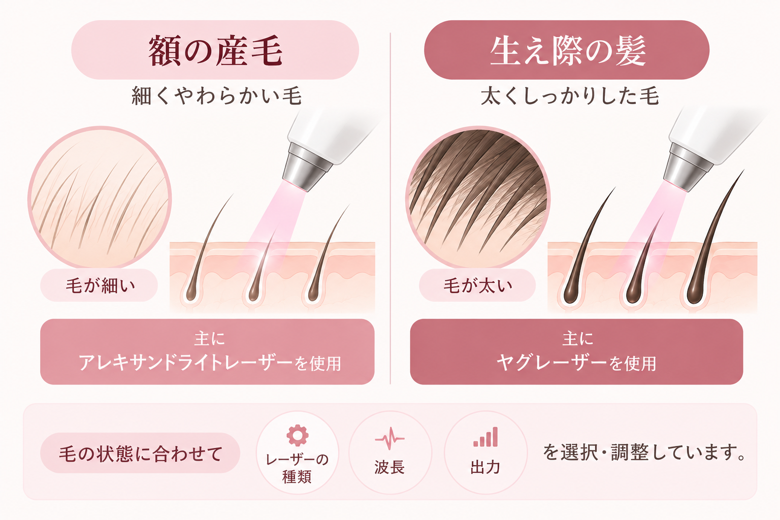 額を広げるには髪の毛部分への照射が必要になることがある