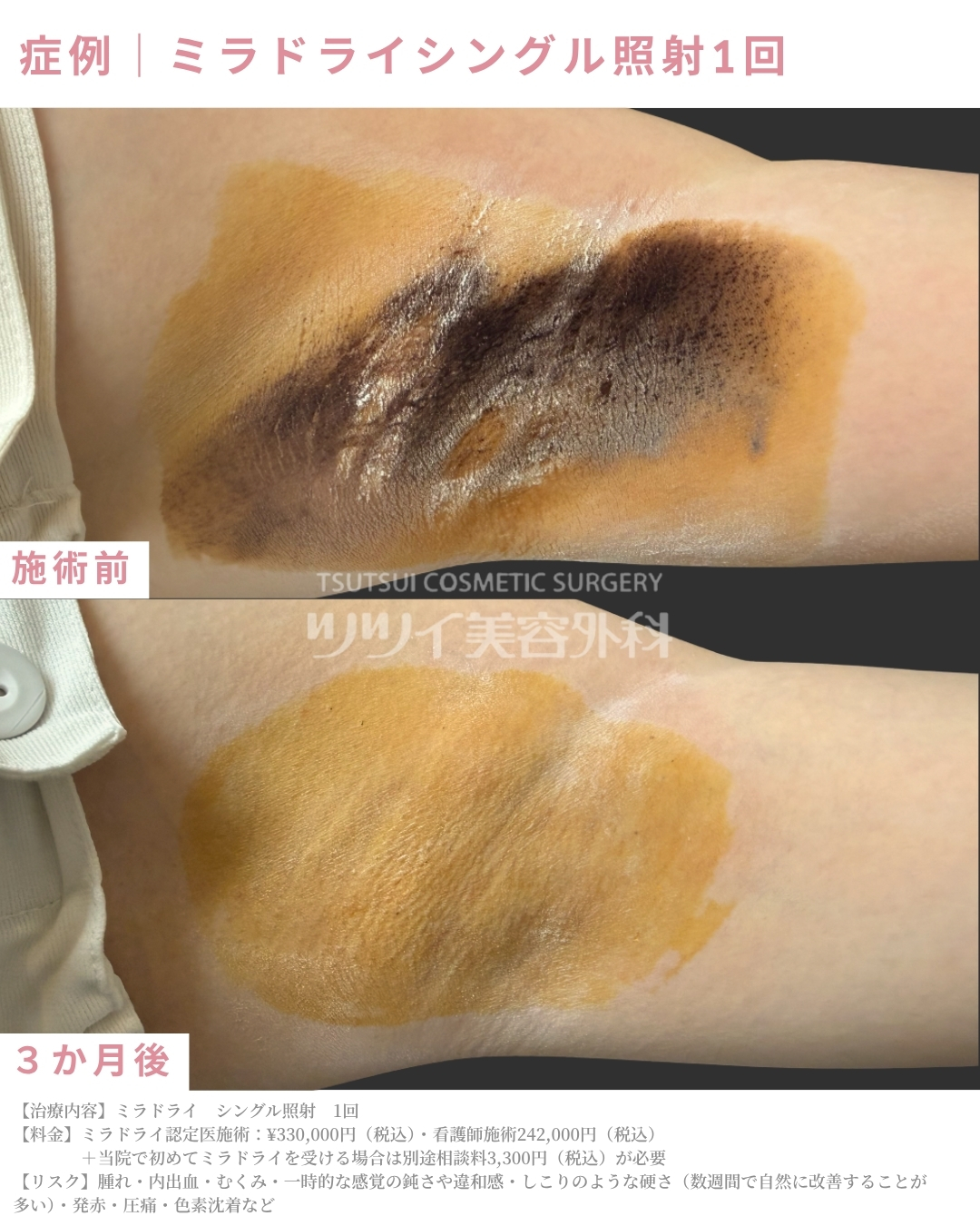 ミラドライ症例①