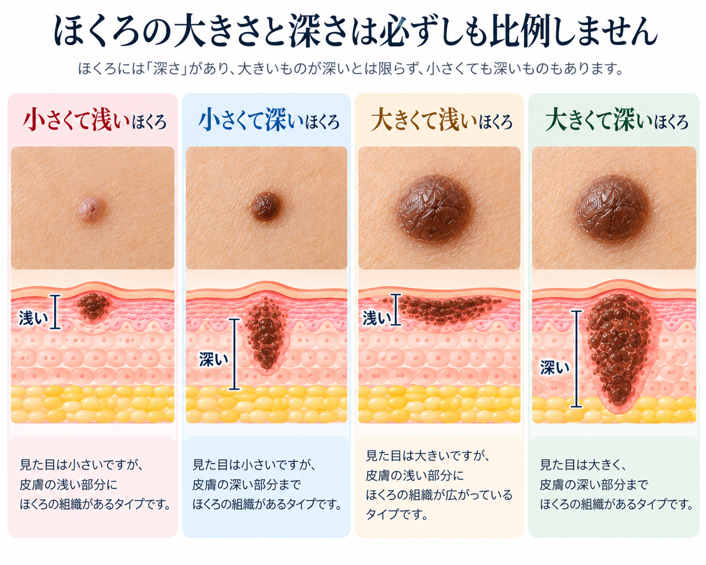 ほくろの大きさと深さは必ずしも比例しません
