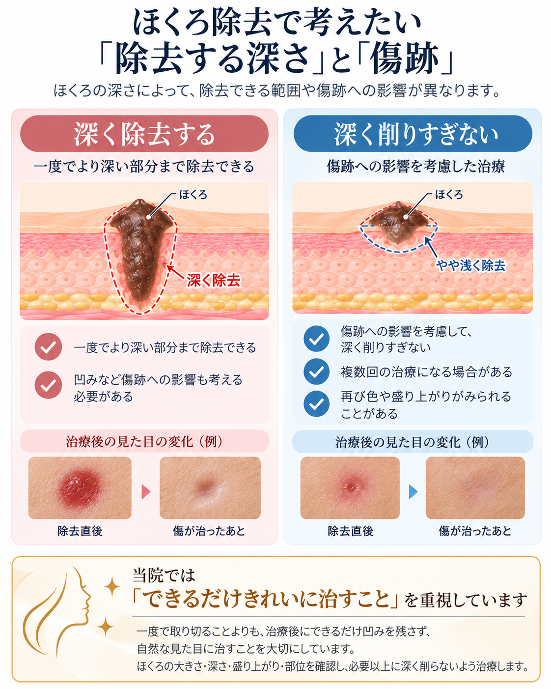 ほくろ除去で考えたい「除去の深さ」と「傷跡」