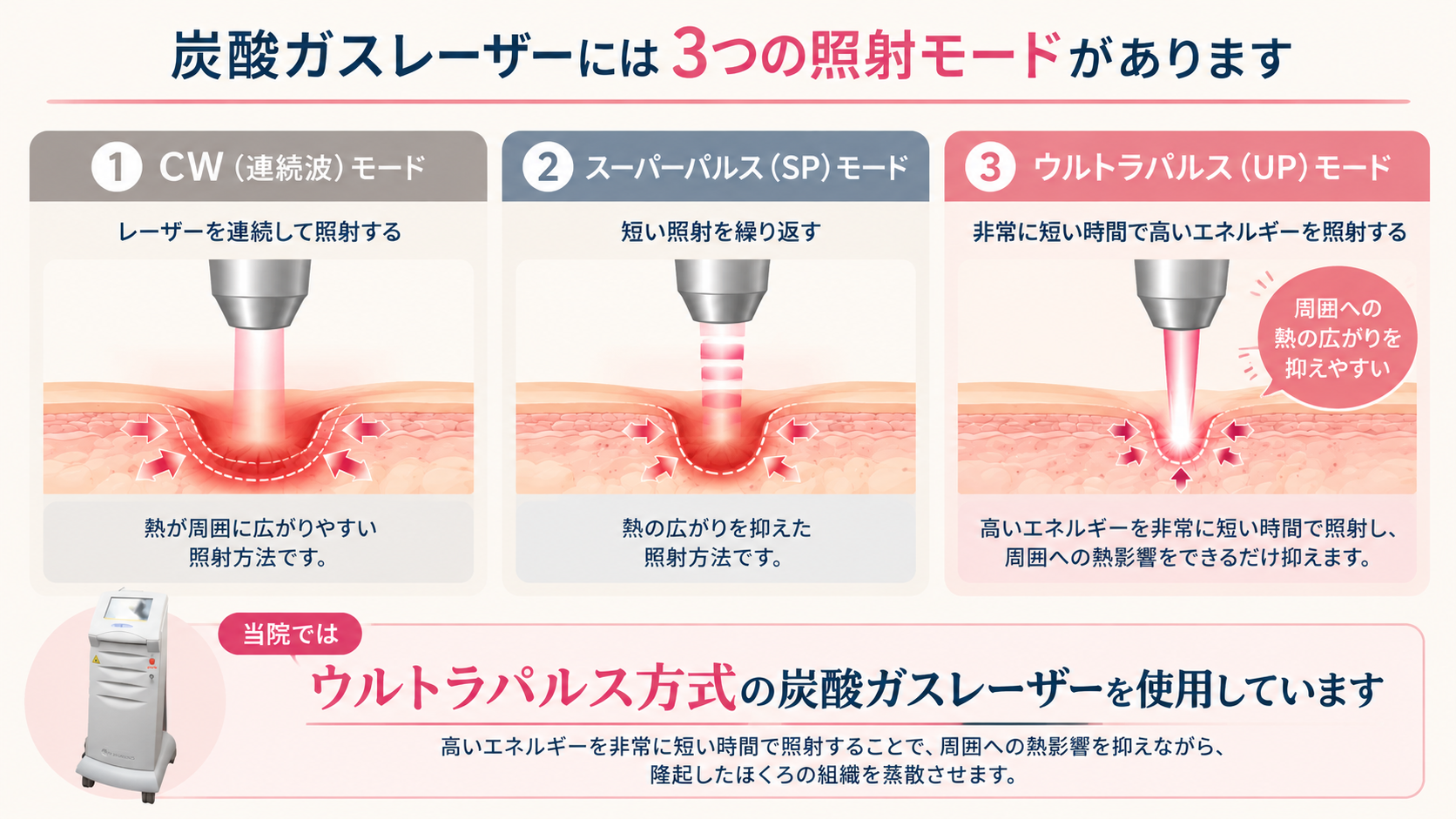 炭酸ガスレーザーには3つの照射モードがあります