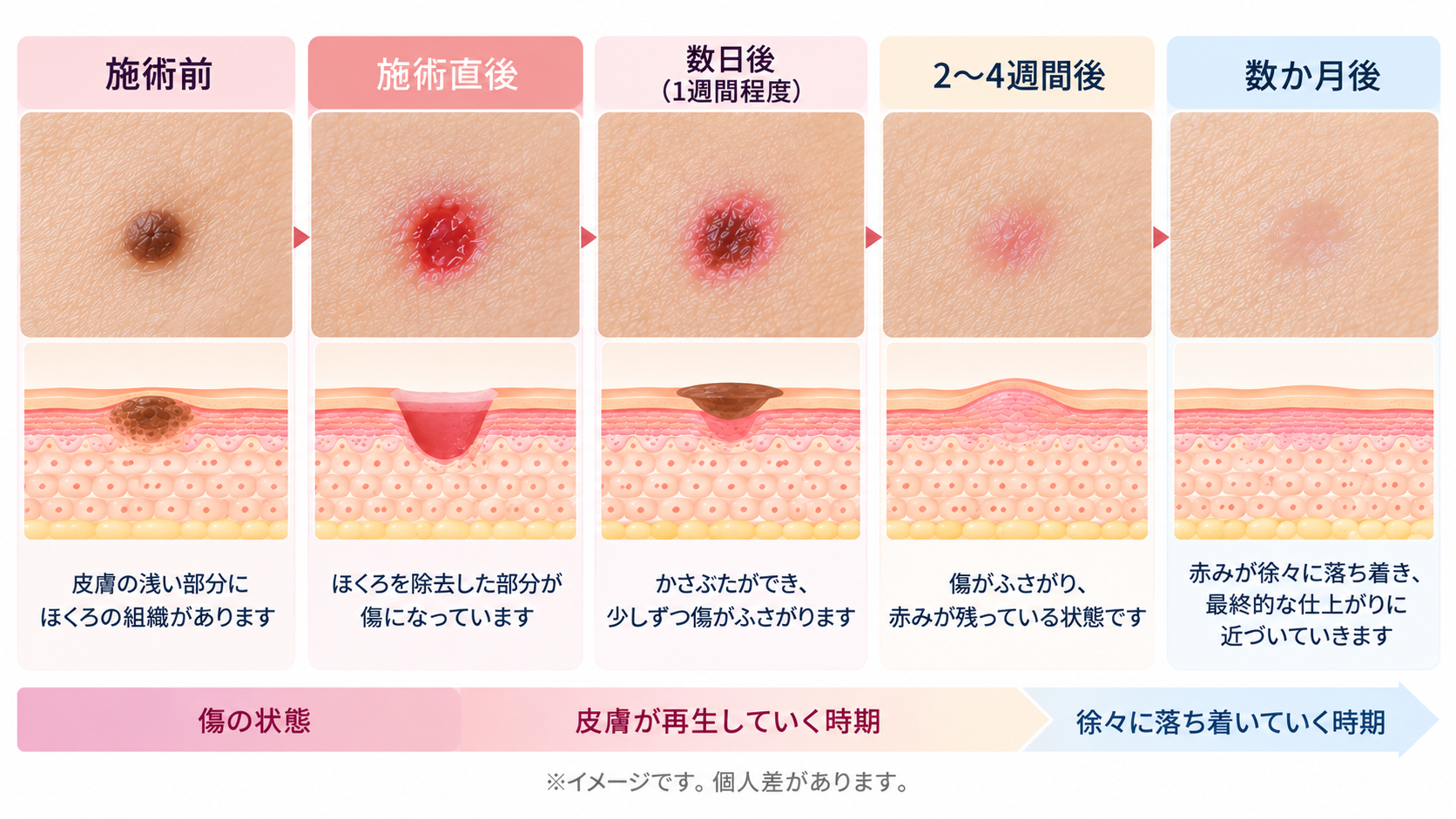 ほくろ除去後の経過