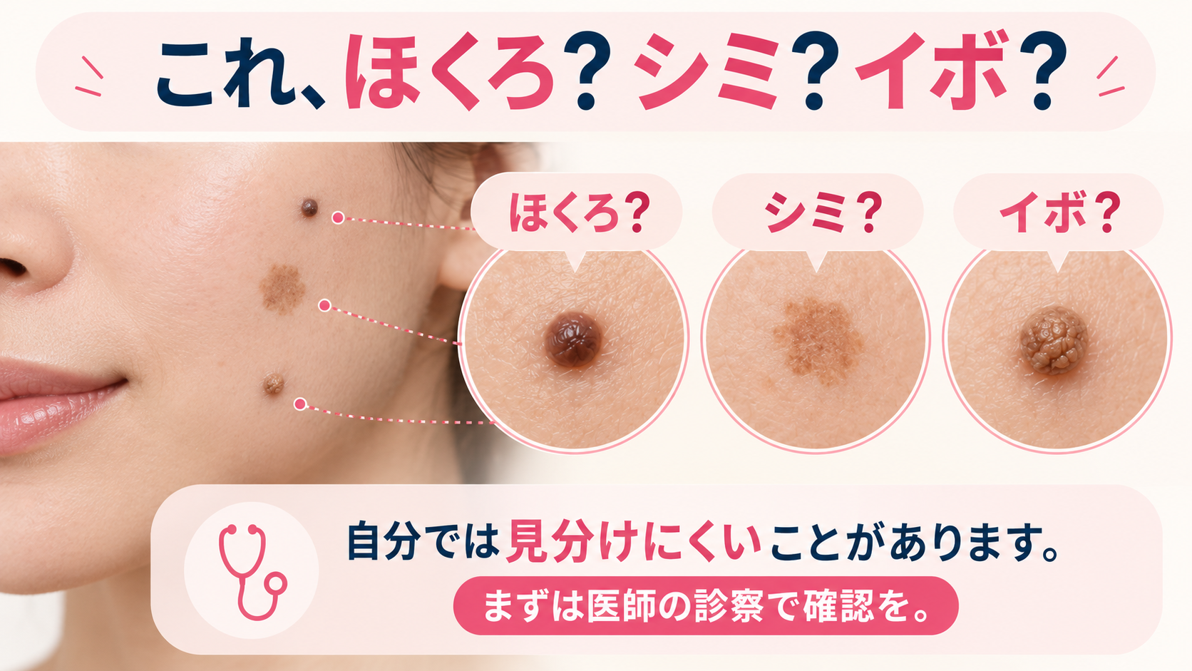 これ、ほくろ?シミ?イボ?自分では見分けにくいことがあります。まずは医師の診察で確認を。
