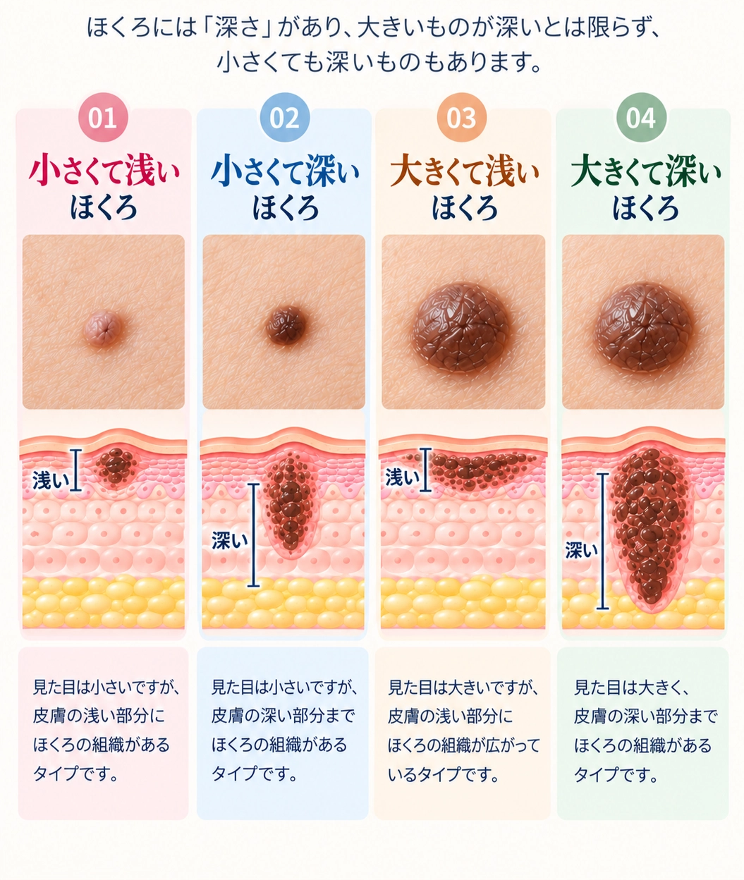 ほくろには「深さ」があり、大きいものが深いとは限らず、小さくても深いものもあります。