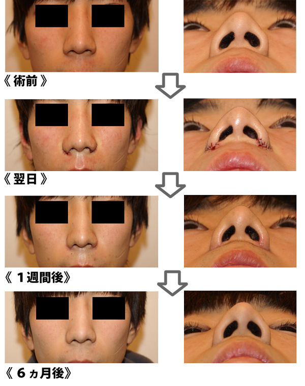 小鼻縮小術 症例写真 画像 ツツイ美容外科 大阪 心斎橋