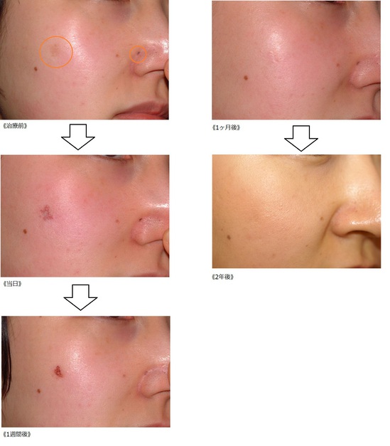 レーザー 経過 ほくろ