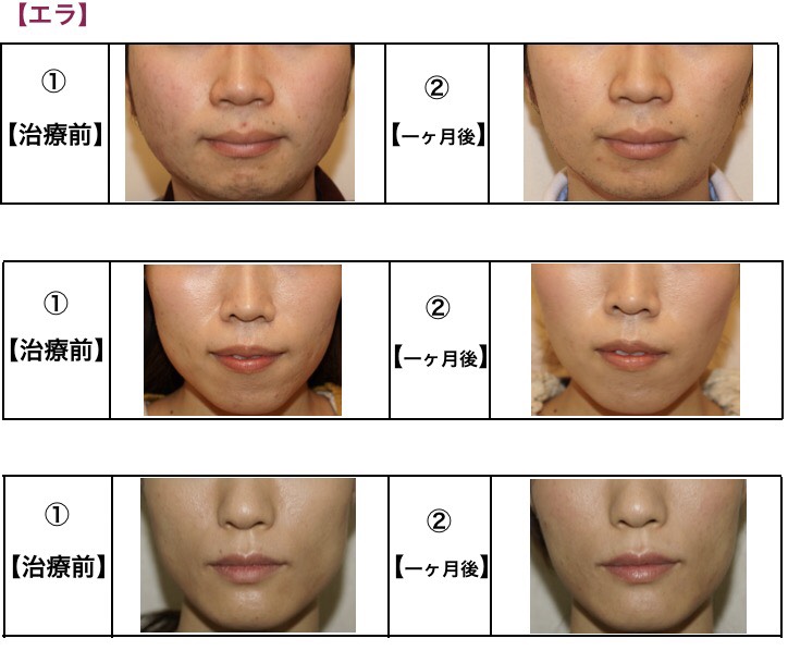 ほほ エラの筋肉 をほっそりする 大阪の美容整形 ツツイ美容外科 美容皮膚科 心斎橋