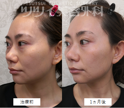 Hifuハイフの効果はいつから 痛み副作用 顔のリフトアップ効果の経過を体験レポート ツツイ美容外科 大阪 心斎橋