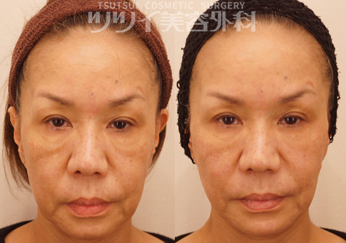 代 30代 40代の老け顔ポイントは 美容皮膚科がおすすめする 老け顔 を治す治療方法とは 大阪 心斎橋のツツイ美容外科ブログ