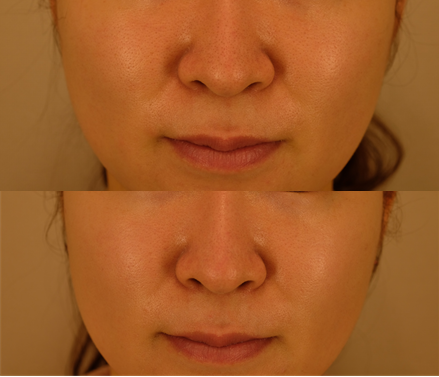 毛穴の開き 症例写真 画像 ツツイ美容外科 大阪 心斎橋