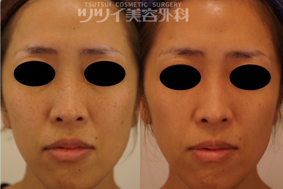 シミ そばかす 症例写真 画像 ツツイ美容外科 大阪 心斎橋 シミ そばかす 症例写真 画像 ツツイ美容外科 大阪 心斎橋