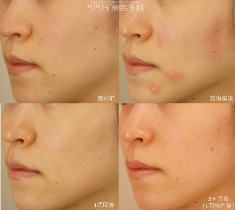 小倉のほくろ除去はケーズ皮膚科・美容皮膚科