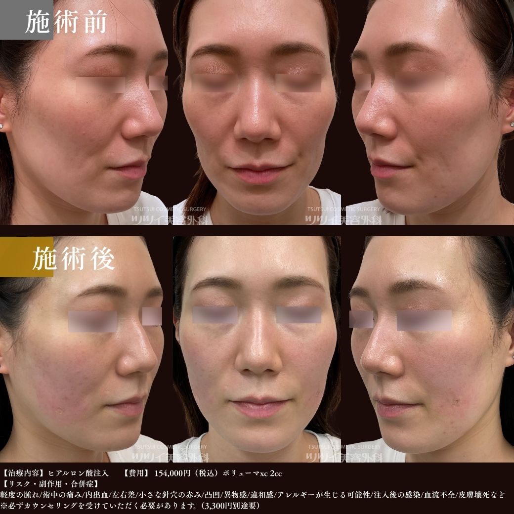 ヒアルロン酸症例
