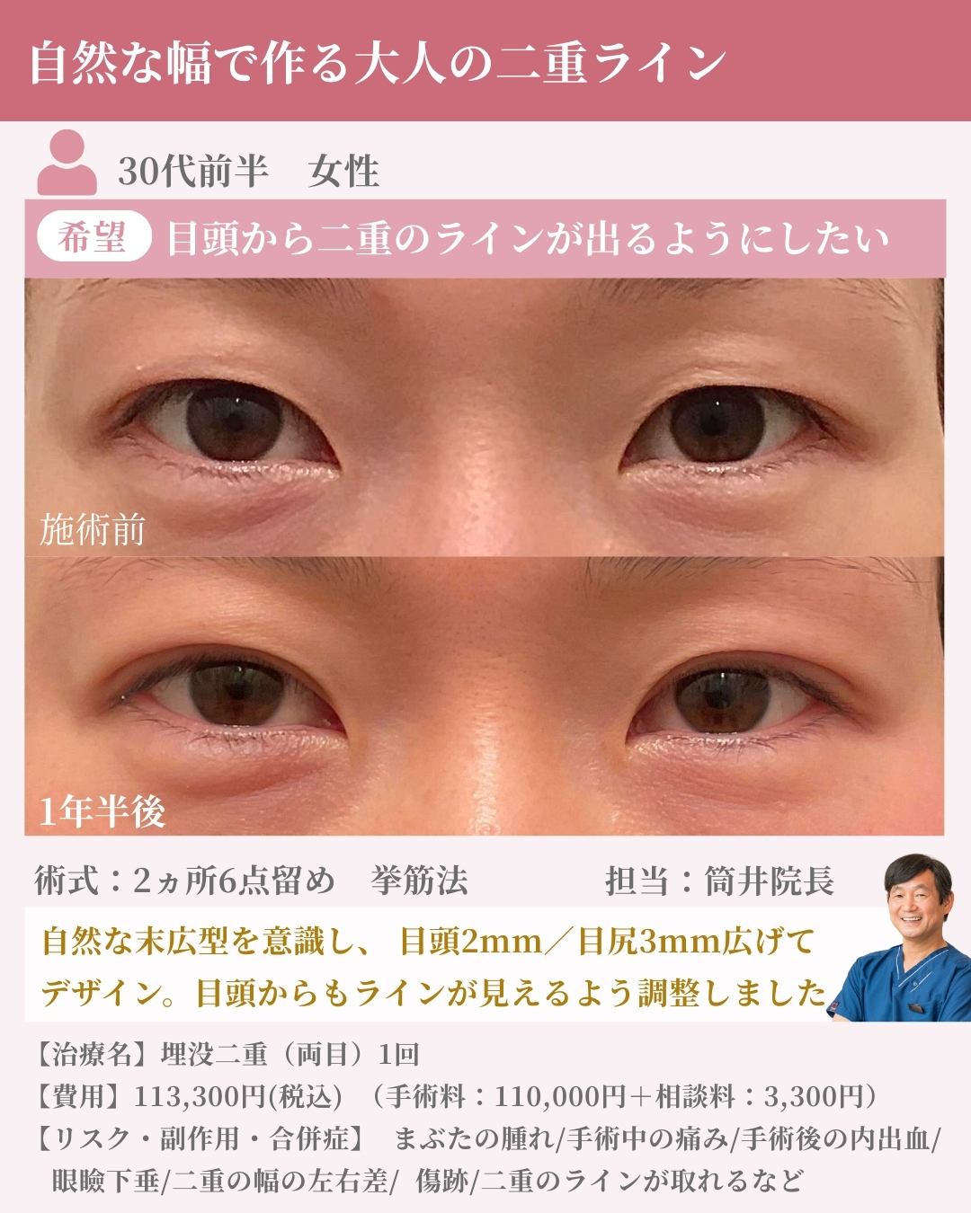 ツツイ美容外科　埋没　症例