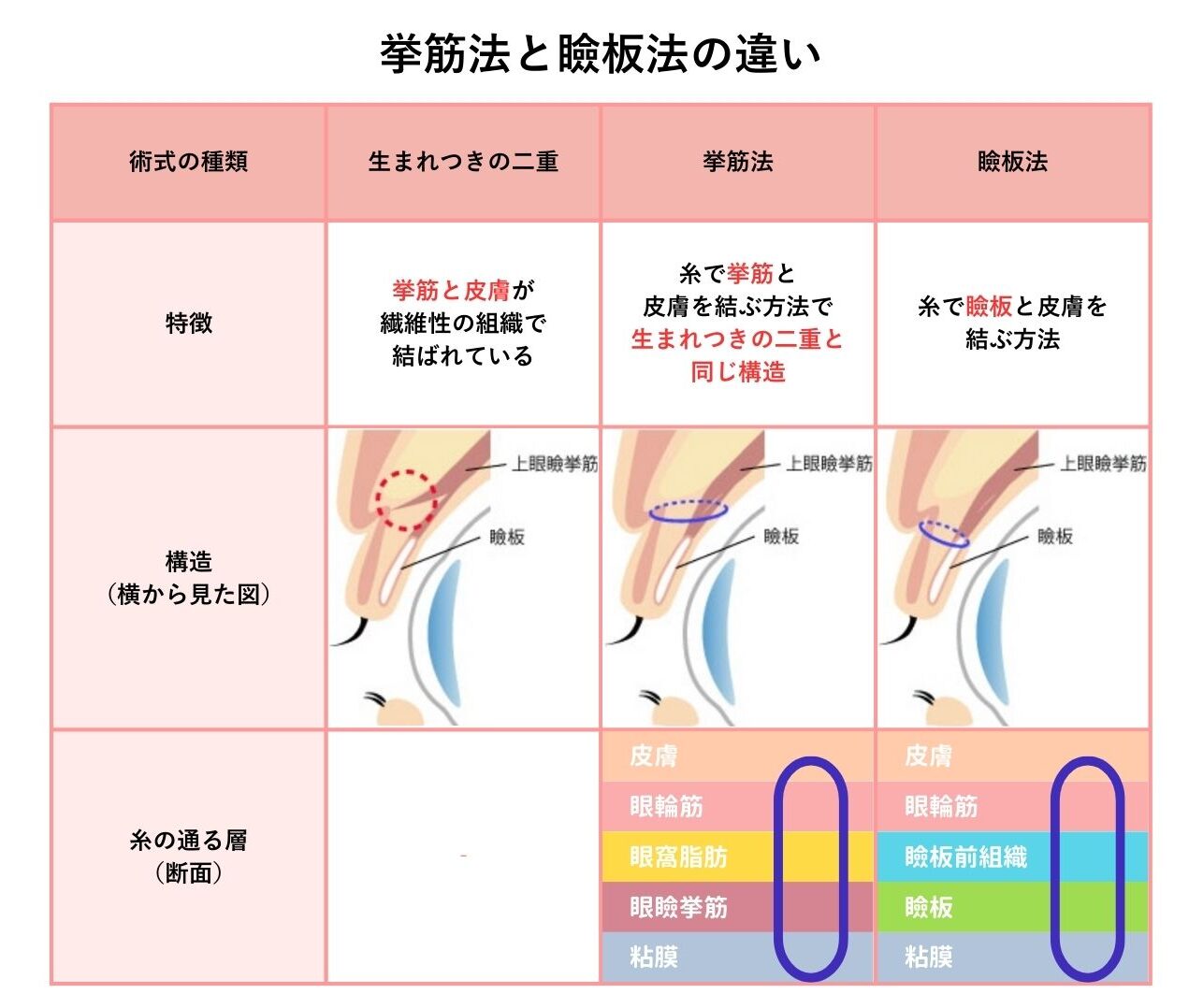 埋没二重　挙筋法　瞼板法　違い