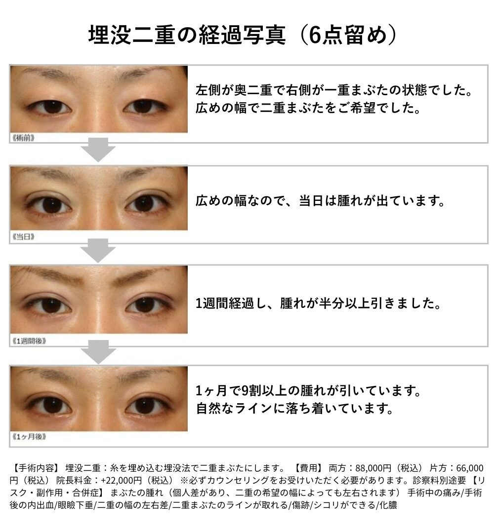 埋没二重　経過写真　6点留め