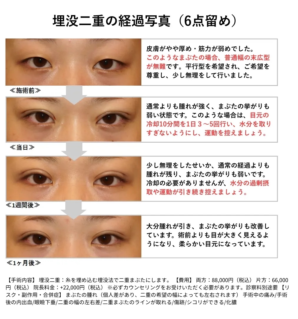 埋没二重　経過写真　6点留め