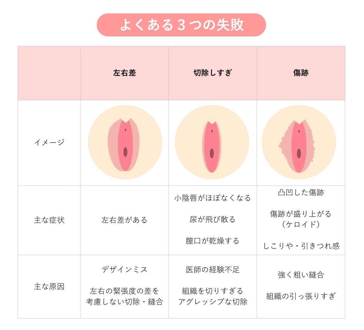 小陰唇縮小術 よくある3つの失敗 イラスト説明