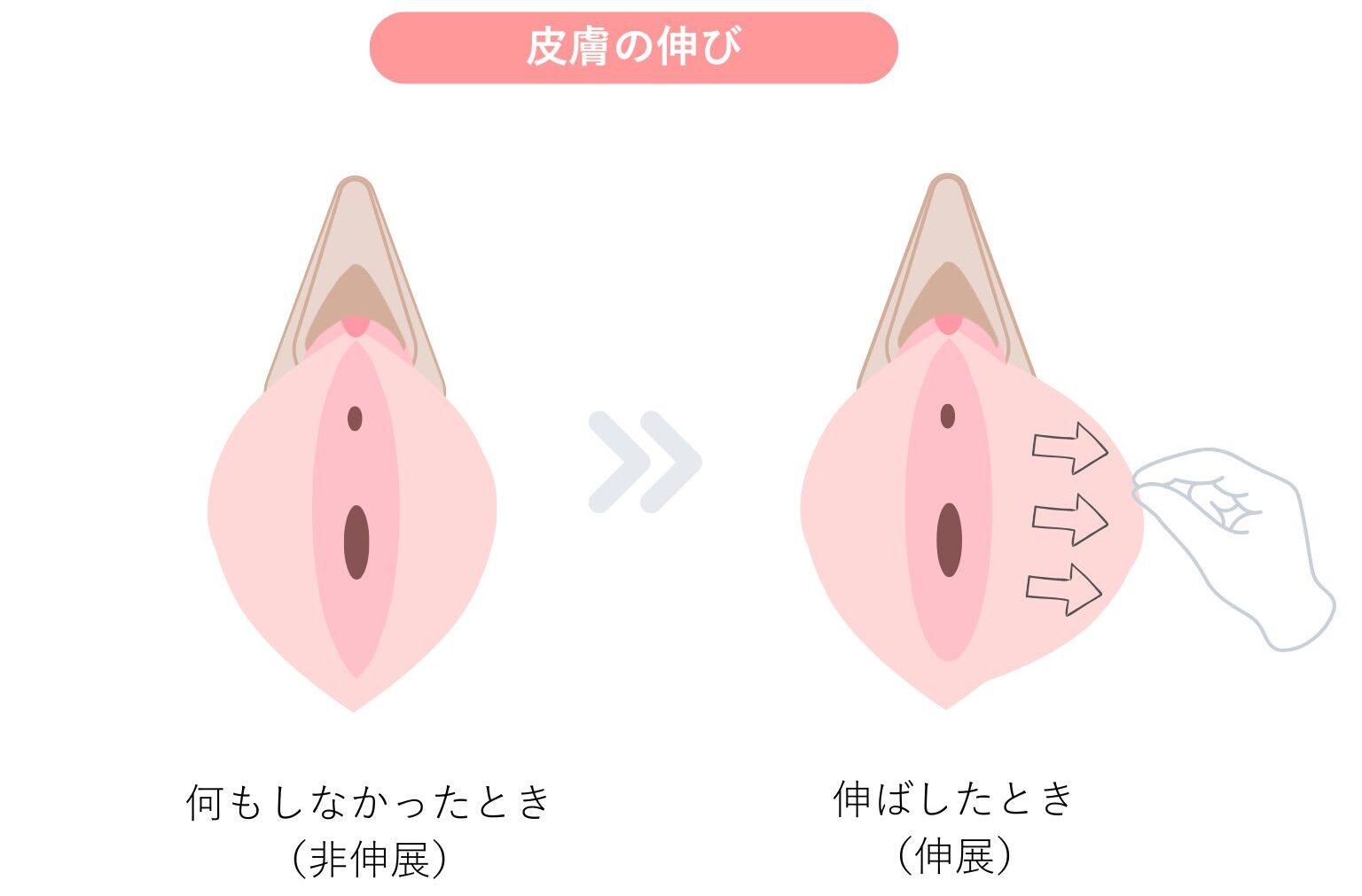 小陰唇縮小術 失敗例 解説