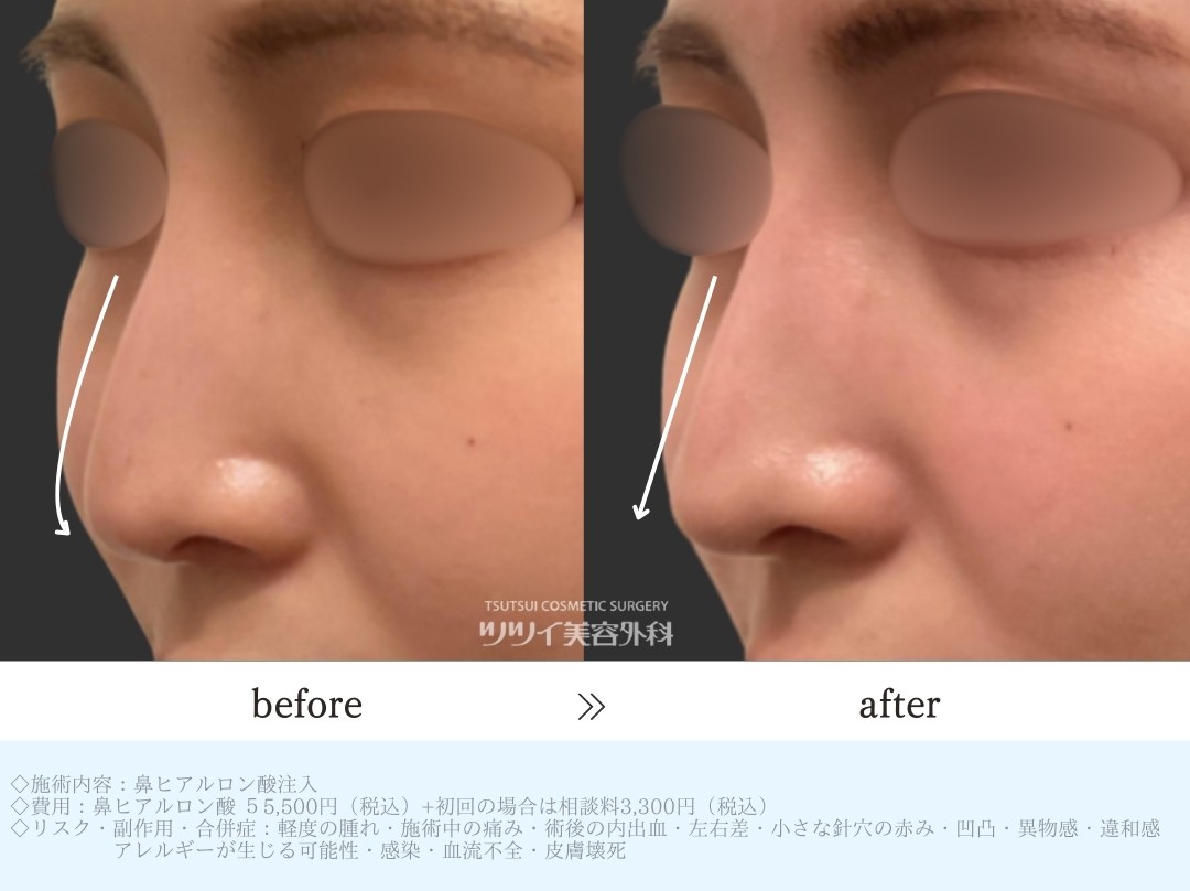 ヒアルロン酸_鼻症例